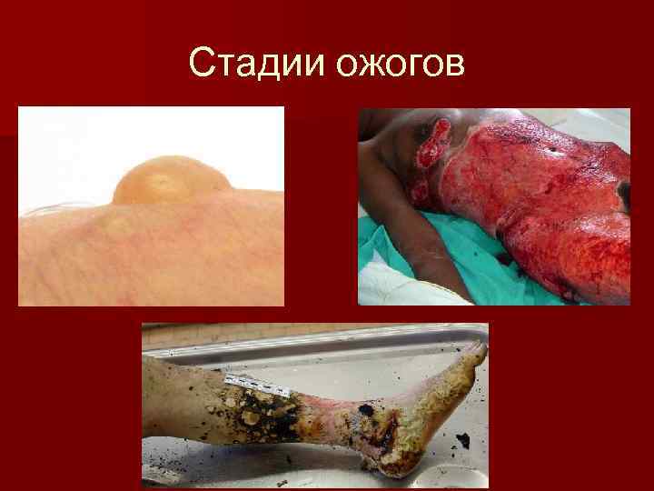 Стадии ожогов 