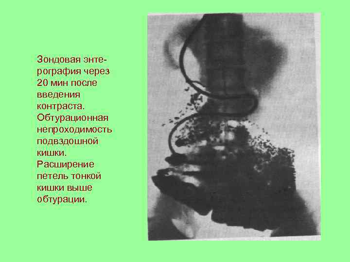 Зондовая энте- рография через 20 мин после введения контраста. Обтурационная непроходимость подвздошной кишки. Расширение
