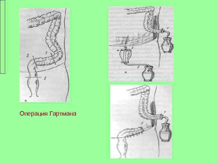 Операция Гартмана 