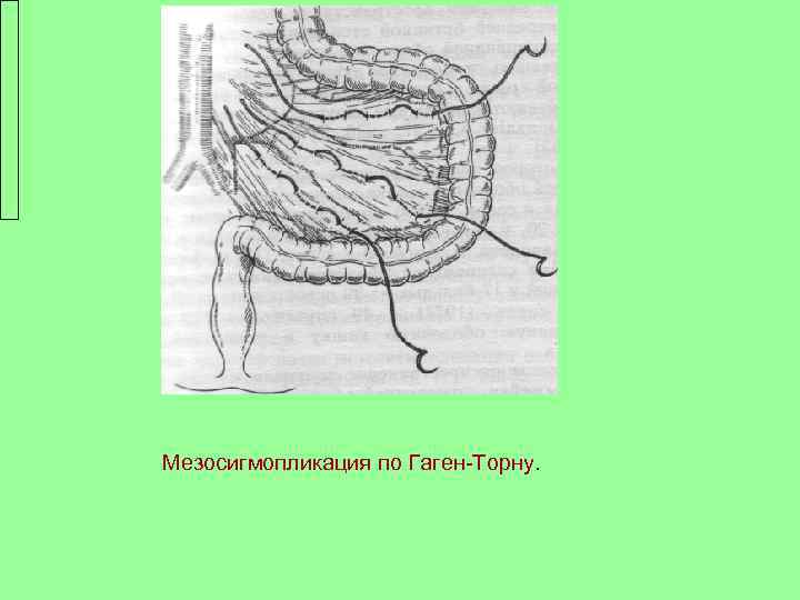 Мезосигмопликация по Гаген-Торну. 
