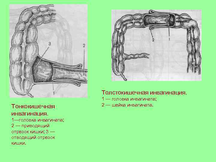     Толстокишечная инвагинация.     1 — головка инвагината;
