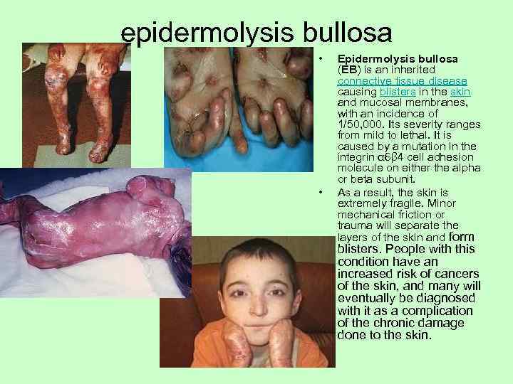 epidermolysis bullosa   •  Epidermolysis bullosa     (EB) is