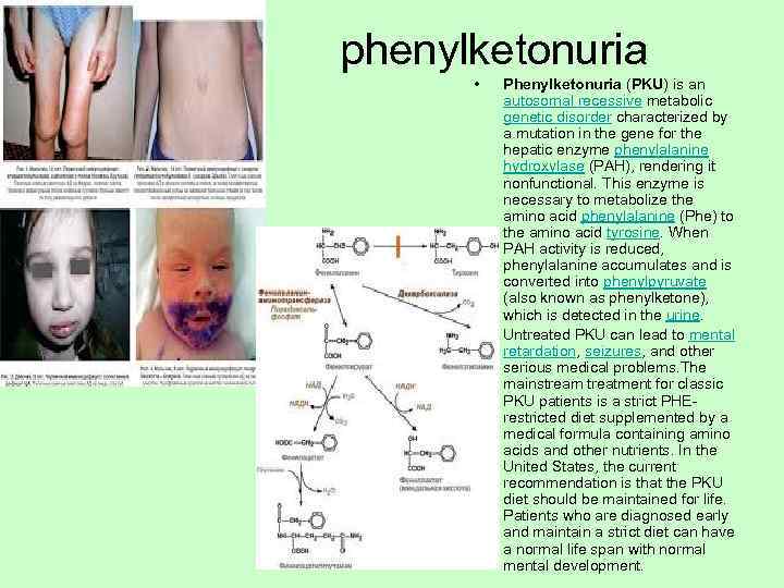    phenylketonuria    •  Phenylketonuria (PKU) is an 
