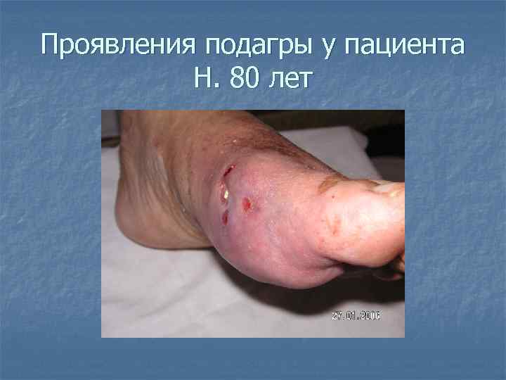 Проявления подагры у пациента  Н. 80 лет 