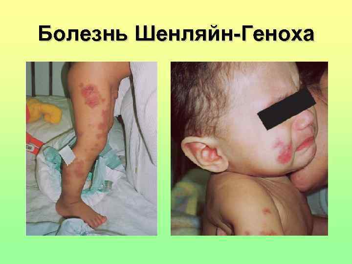 Болезнь Шенляйн-Геноха 