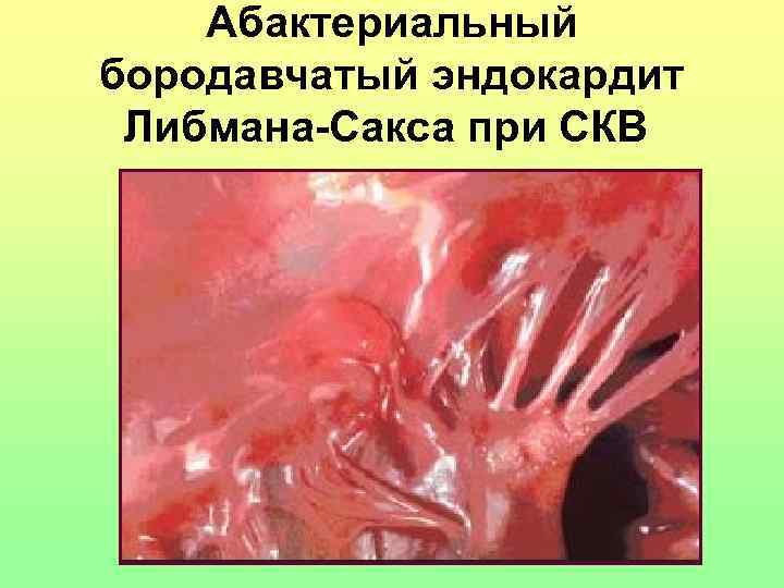   Абактериальный бородавчатый эндокардит  Либмана-Сакса при СКВ  