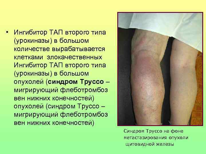  • Ингибитор ТАП второго типа  (урокиназы) в большом  количестве вырабатывается 