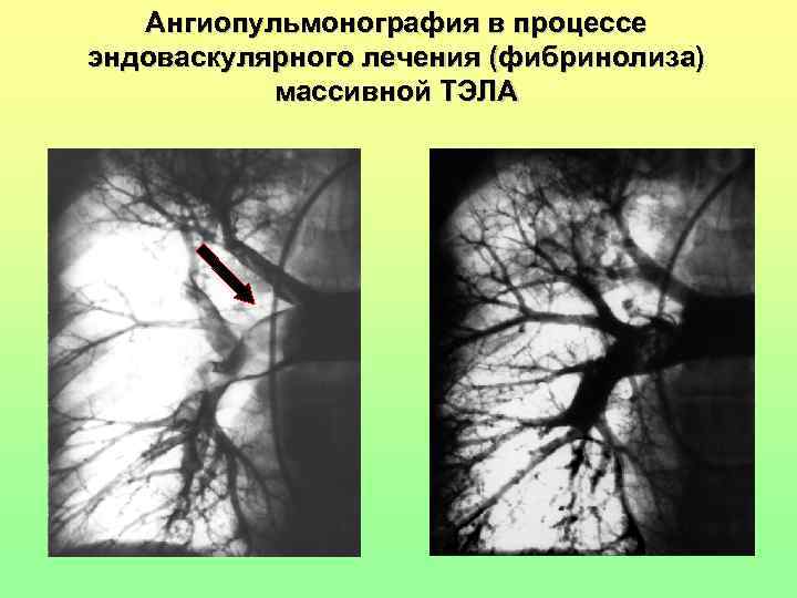   Ангиопульмонография в процессе эндоваскулярного лечения (фибринолиза)   массивной ТЭЛА 