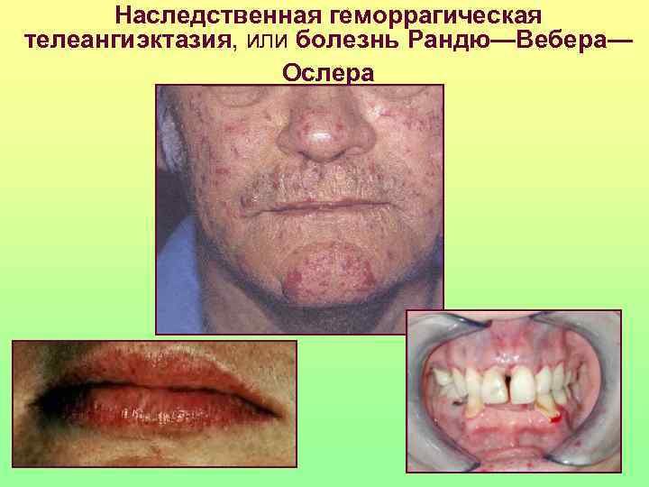  Наследственная геморрагическая телеангиэктазия, или болезнь Рандю—Вебера—     Ослера 