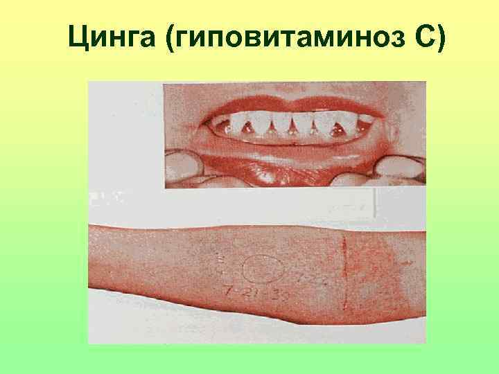 Цинга (гиповитаминоз С) 