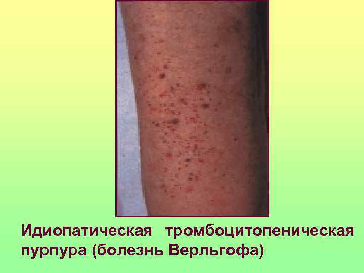 Идиопатическая тромбоцитопеническая пурпура (болезнь Верльгофа) 