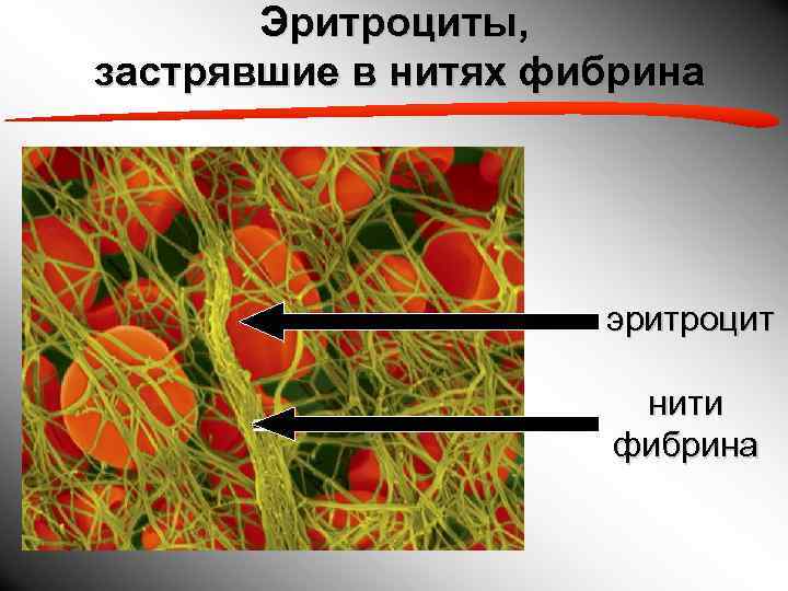   Эритроциты, застрявшие в нитях фибрина     эритроцит  