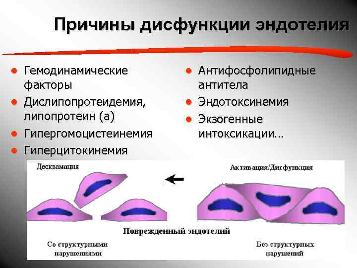  Причины дисфункции эндотелия ● Гемодинамические  ● Антифосфолипидные  факторы   антитела