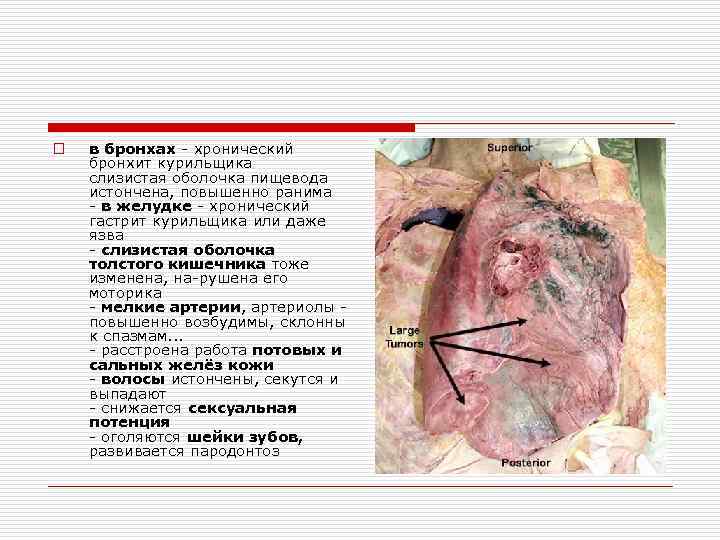 o  в бронхах - хронический бронхит курильщика слизистая оболочка пищевода истончена, повышенно ранима