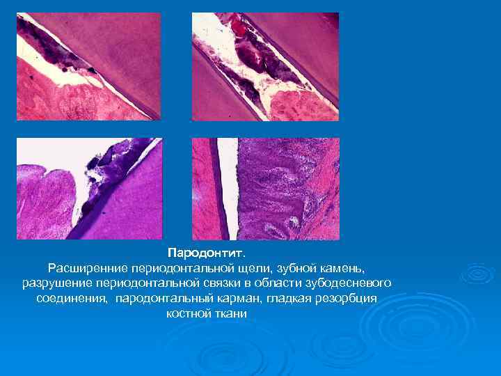      Пародонтит. Расширенние периодонтальной щели, зубной камень, разрушение периодонтальной связки