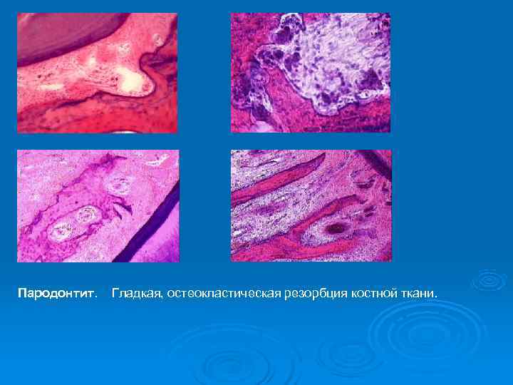 Пародонтит.  Гладкая, остеокластическая резорбция костной ткани. 