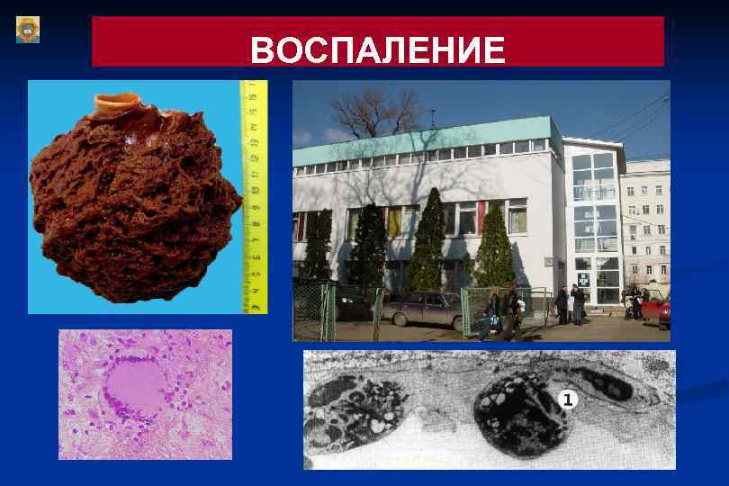 ВОСПАЛЕНИЕ 