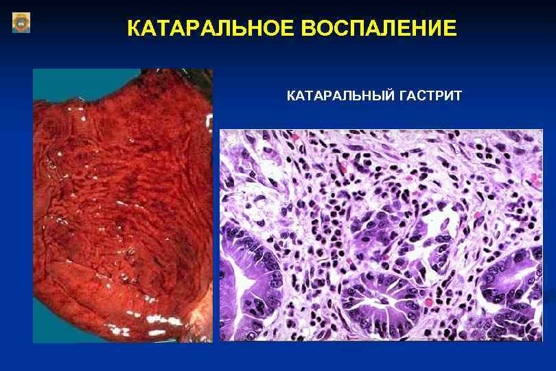 Двусторонний диффузный катаральный эндобронхит на фоне атрофии слизистой