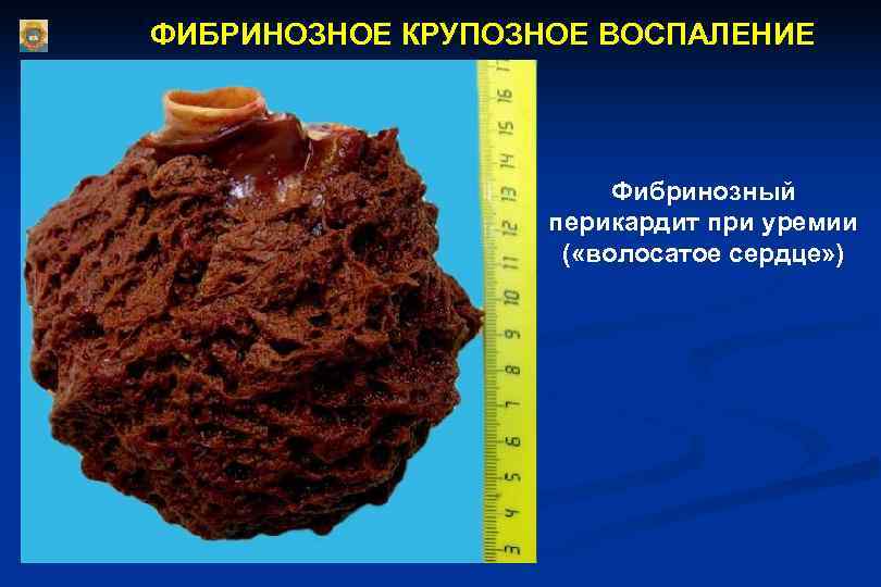 ФИБРИНОЗНОЕ КРУПОЗНОЕ ВОСПАЛЕНИЕ     Фибринозный    перикардит при уремии
