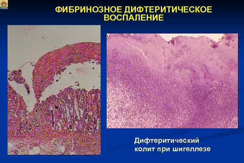 Пневмония при колите. Дифтеритический колит макропрепарат. Дифтеритическое воспаление кишечника, патоморфология:. Дифтерический колит гистология. Фибринозное воспаление патанатомия.