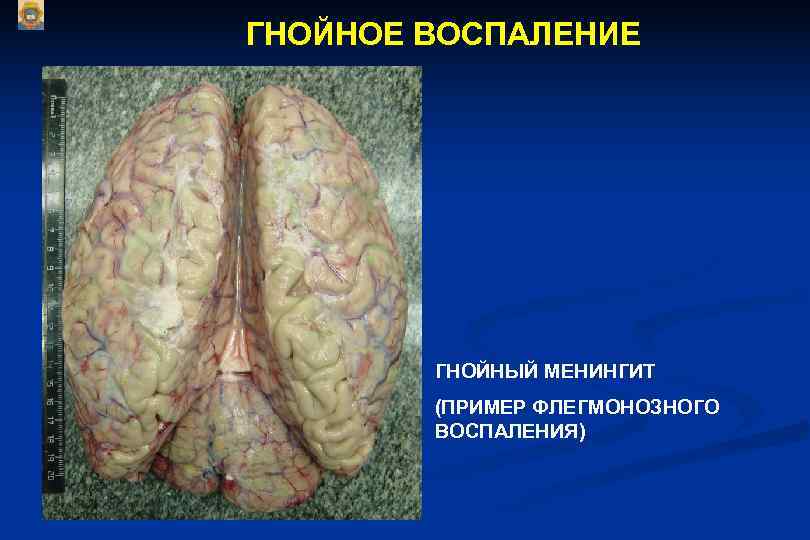ГНОЙНОЕ ВОСПАЛЕНИЕ   ГНОЙНЫЙ МЕНИНГИТ   (ПРИМЕР ФЛЕГМОНОЗНОГО   ВОСПАЛЕНИЯ) 