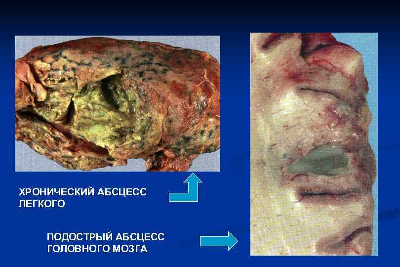 ХРОНИЧЕСКИЙ АБСЦЕСС ЛЕГКОГО  ПОДОСТРЫЙ АБСЦЕСС ГОЛОВНОГО МОЗГА 