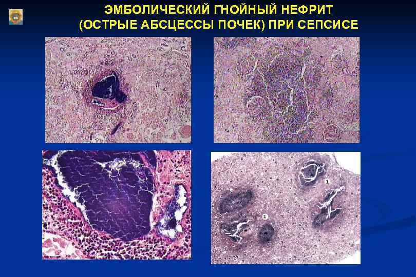   ЭМБОЛИЧЕСКИЙ ГНОЙНЫЙ НЕФРИТ (ОСТРЫЕ АБСЦЕССЫ ПОЧЕК) ПРИ СЕПСИСЕ 