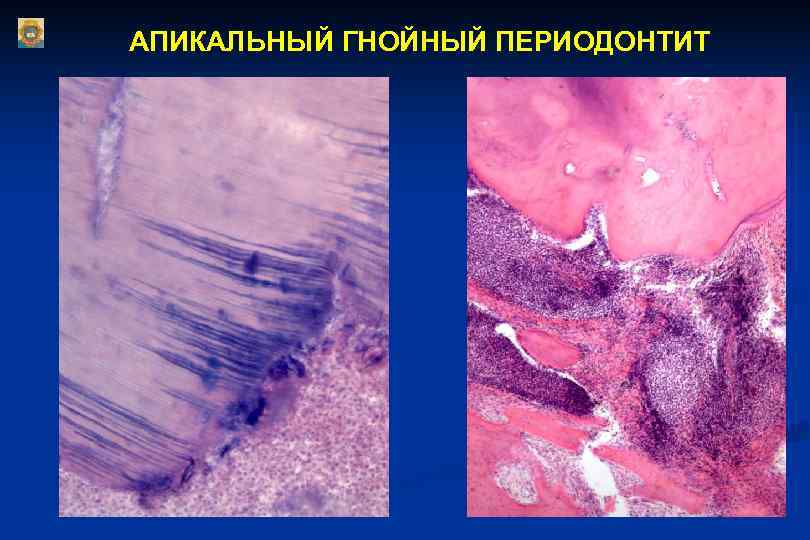 АПИКАЛЬНЫЙ ГНОЙНЫЙ ПЕРИОДОНТИТ 