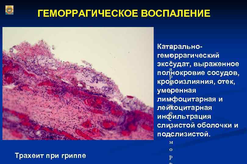  ГЕМОРРАГИЧЕСКОЕ ВОСПАЛЕНИЕ     Катарально-     к 