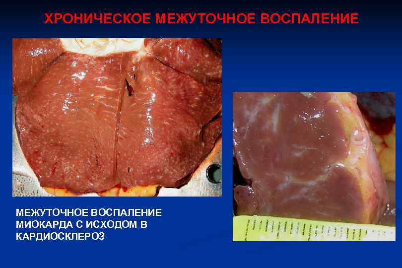   ХРОНИЧЕСКОЕ МЕЖУТОЧНОЕ ВОСПАЛЕНИЕ МИОКАРДА С ИСХОДОМ В КАРДИОСКЛЕРОЗ 