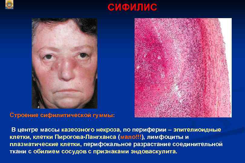      СИФИЛИС Строение сифилитической гуммы:  В центре массы казеозного