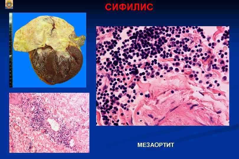 СИФИЛИС   МЕЗАОРТИТ 