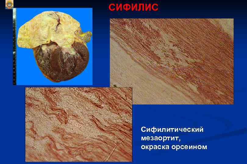 СИФИЛИС   Сифилитический мезаортит, окраска орсеином 