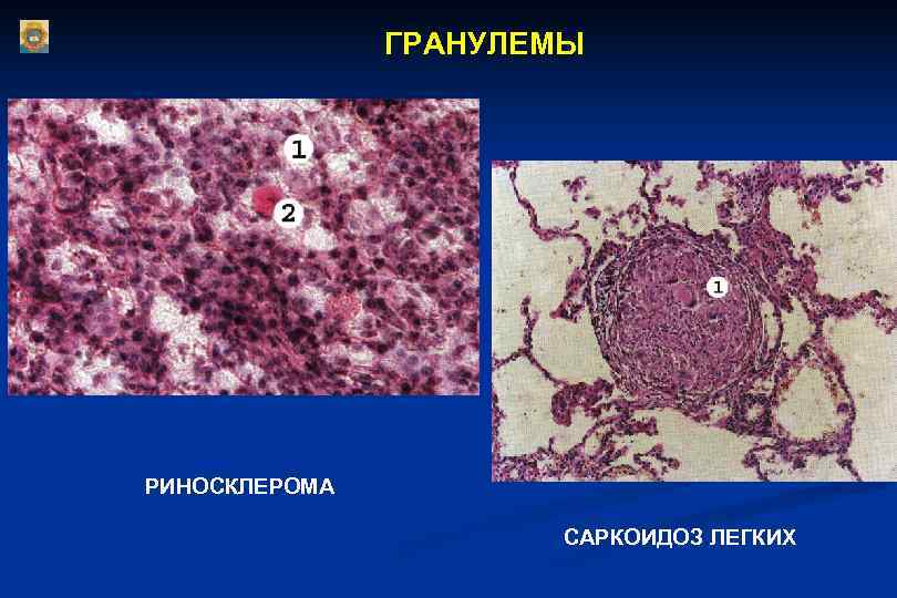     ГРАНУЛЕМЫ РИНОСКЛЕРОМА     САРКОИДОЗ ЛЕГКИХ 
