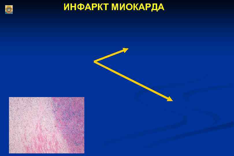 ИНФАРКТ МИОКАРДА ИНФАРКТ МИОКАРДА