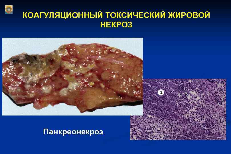 КОАГУЛЯЦИОННЫЙ ТОКСИЧЕСКИЙ ЖИРОВОЙ НЕКРОЗ Панкреонекроз КОАГУЛЯЦИОННЫЙ ТОКСИЧЕСКИЙ ЖИРОВОЙ НЕКРОЗ Панкреонекроз