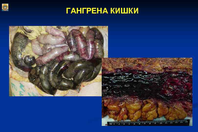 ГАНГРЕНА КИШКИ ГАНГРЕНА КИШКИ
