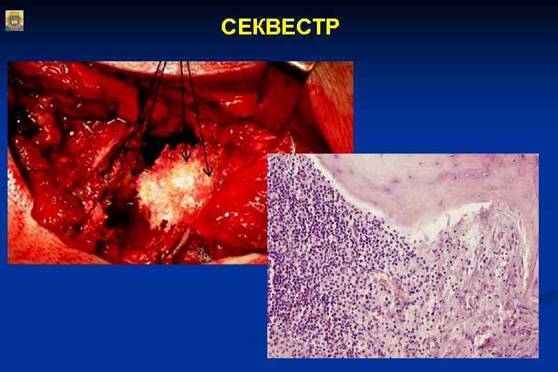 СЕКВЕСТР СЕКВЕСТР