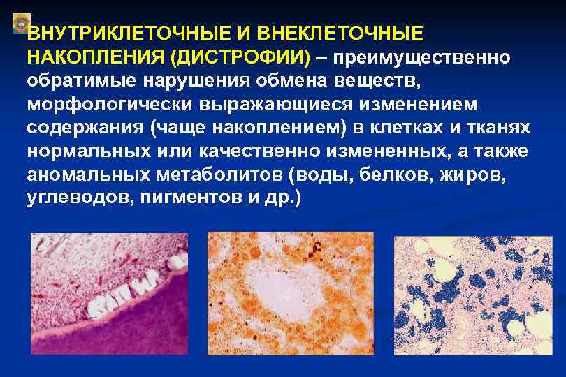 ВНУТРИКЛЕТОЧНЫЕ И ВНЕКЛЕТОЧНЫЕ НАКОПЛЕНИЯ (ДИСТРОФИИ) – преимущественно обратимые нарушения обмена веществ, морфологически выражающиеся изменением ВНУТРИКЛЕТОЧНЫЕ И ВНЕКЛЕТОЧНЫЕ НАКОПЛЕНИЯ (ДИСТРОФИИ) – преимущественно обратимые нарушения обмена веществ, морфологически выражающиеся изменением