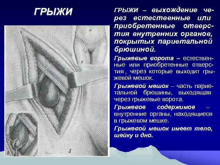 ГРЫЖИ – выхождение че-   рез естественные или   приобретенные отверс- 