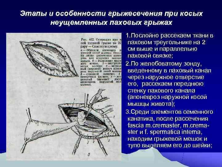 Стол при паховой грыже