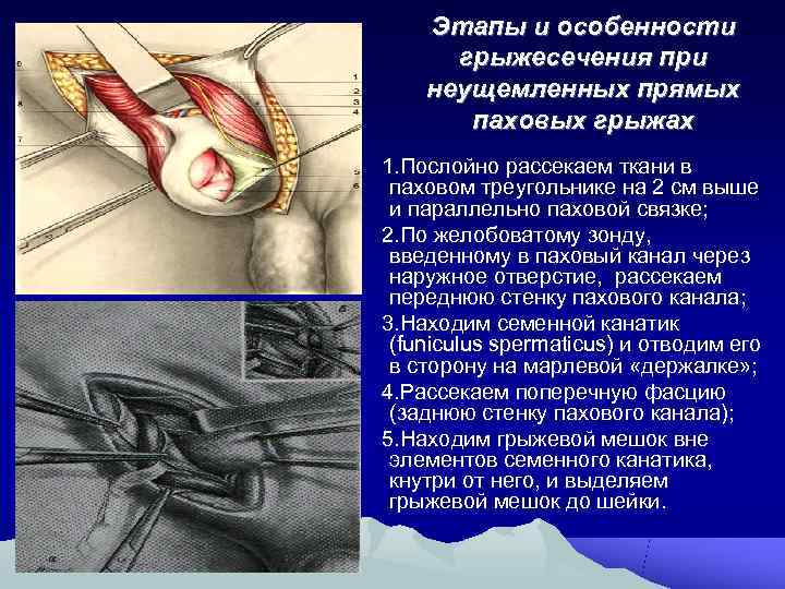   Этапы и особенности  грыжесечения при неущемленных прямых  паховых грыжах 1.