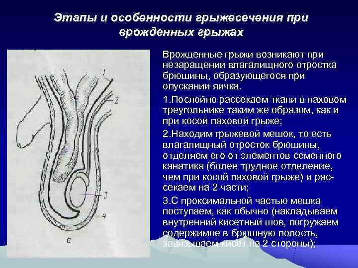 Ущемленная паховая грыжа карта