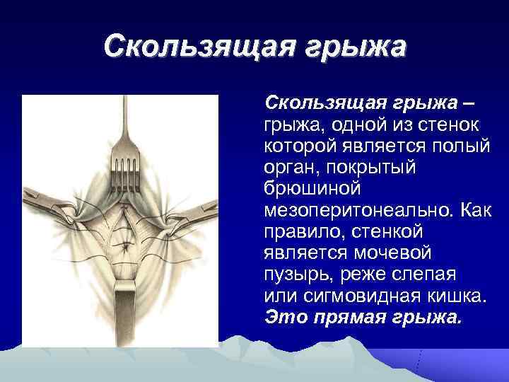 Скользящая грыжа   Скользящая грыжа –   грыжа, одной из стенок 