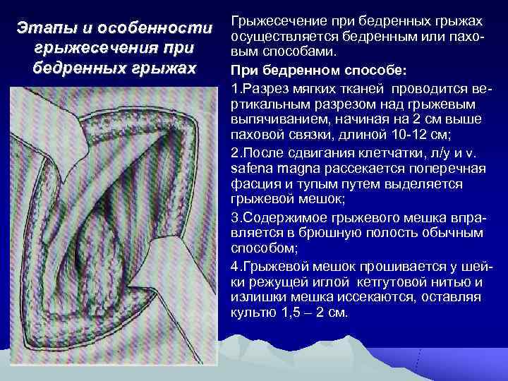      Грыжесечение при бедренных грыжах Этапы и особенности  осуществляется