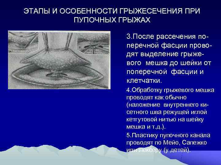 Герниопластика пупочной грыжи. Этапы операции при грыжесечении. Особенности грыжесечения. Основные этапы операции грыжесечения.