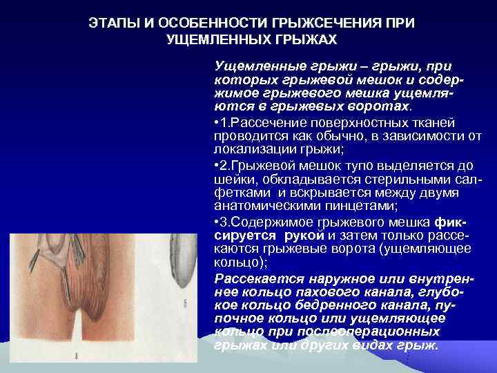 ЭТАПЫ И ОСОБЕННОСТИ ГРЫЖСЕЧЕНИЯ ПРИ   УЩЕМЛЕННЫХ ГРЫЖАХ   Ущемленные грыжи –