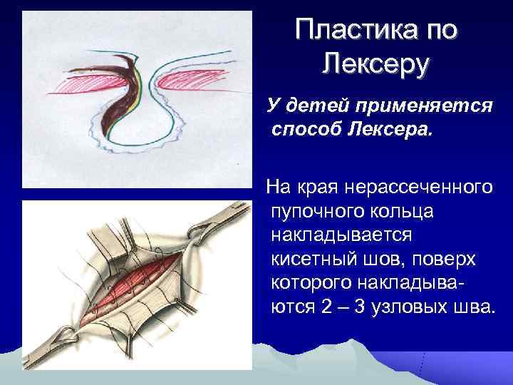 Способы пластики грыж