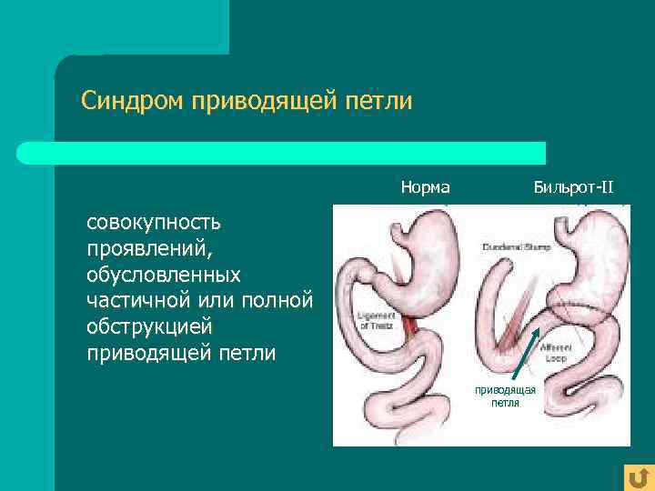 Синдром приводящей петли     Норма  Бильрот-II совокупность проявлений, обусловленных частичной