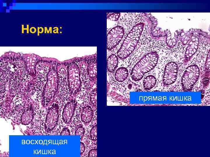 Норма:    прямая кишка восходящая  кишка 